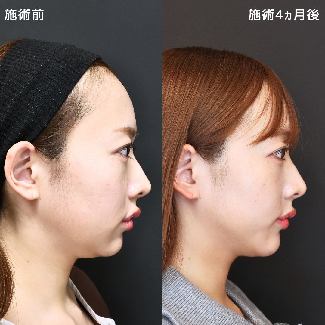 《ナチュラル小顔整形》自信の持てる横顔へ