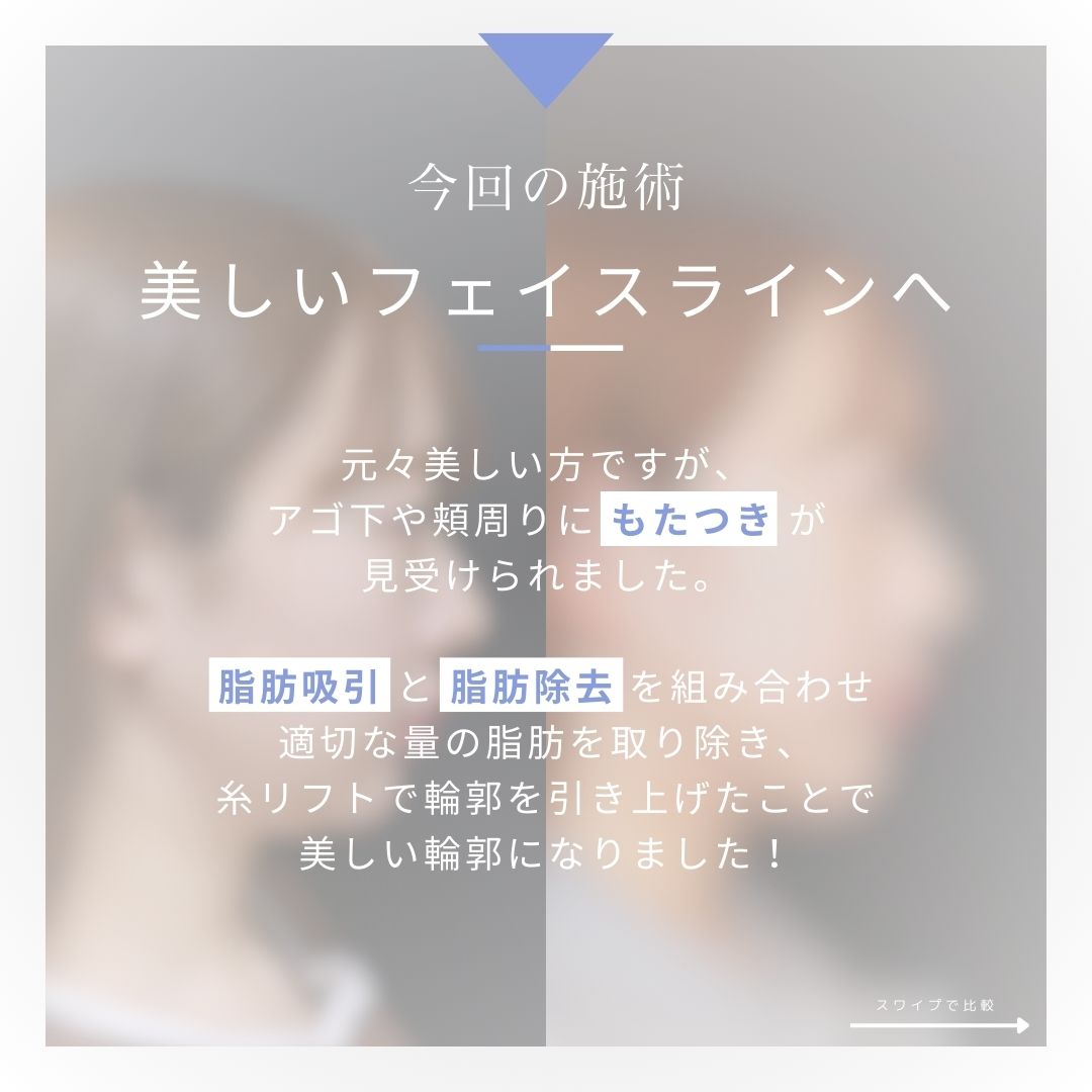 ジョールファット除去/顎下の脂肪吸引/Lラインファット除去（エラ下脂肪除去）の症例写真 施術前後 