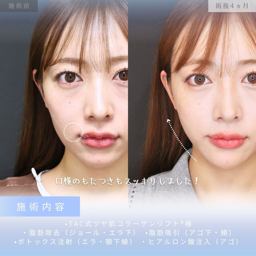 ジョールファット除去/顎下の脂肪吸引/Lラインファット除去（エラ下脂肪除去）の症例写真 施術前後 