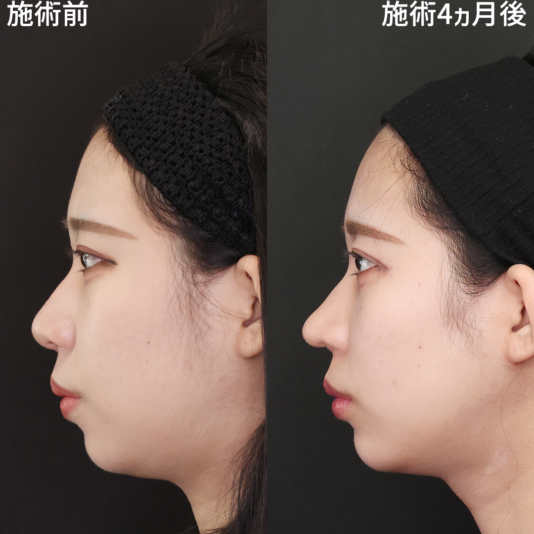 鼻中隔で整う横顔！高さを出してさらに美しく