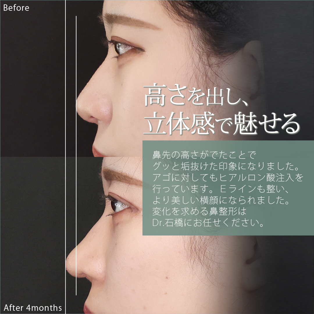 鼻中隔延長術/鼻尖形成・鼻尖縮小/鼻先軟骨移植の症例写真 施術前後 