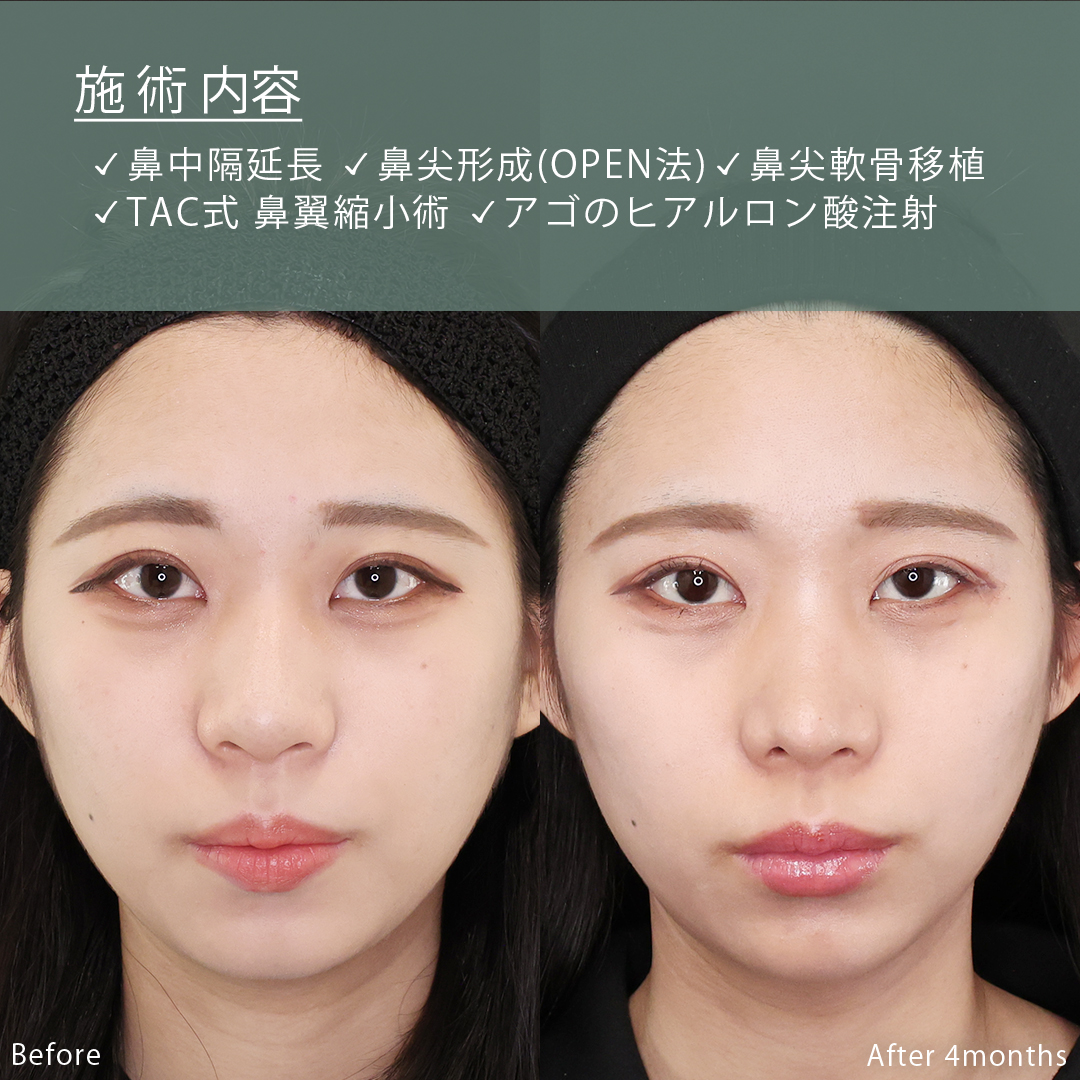 鼻中隔延長術/鼻尖形成・鼻尖縮小/鼻先軟骨移植の症例写真 施術前後 