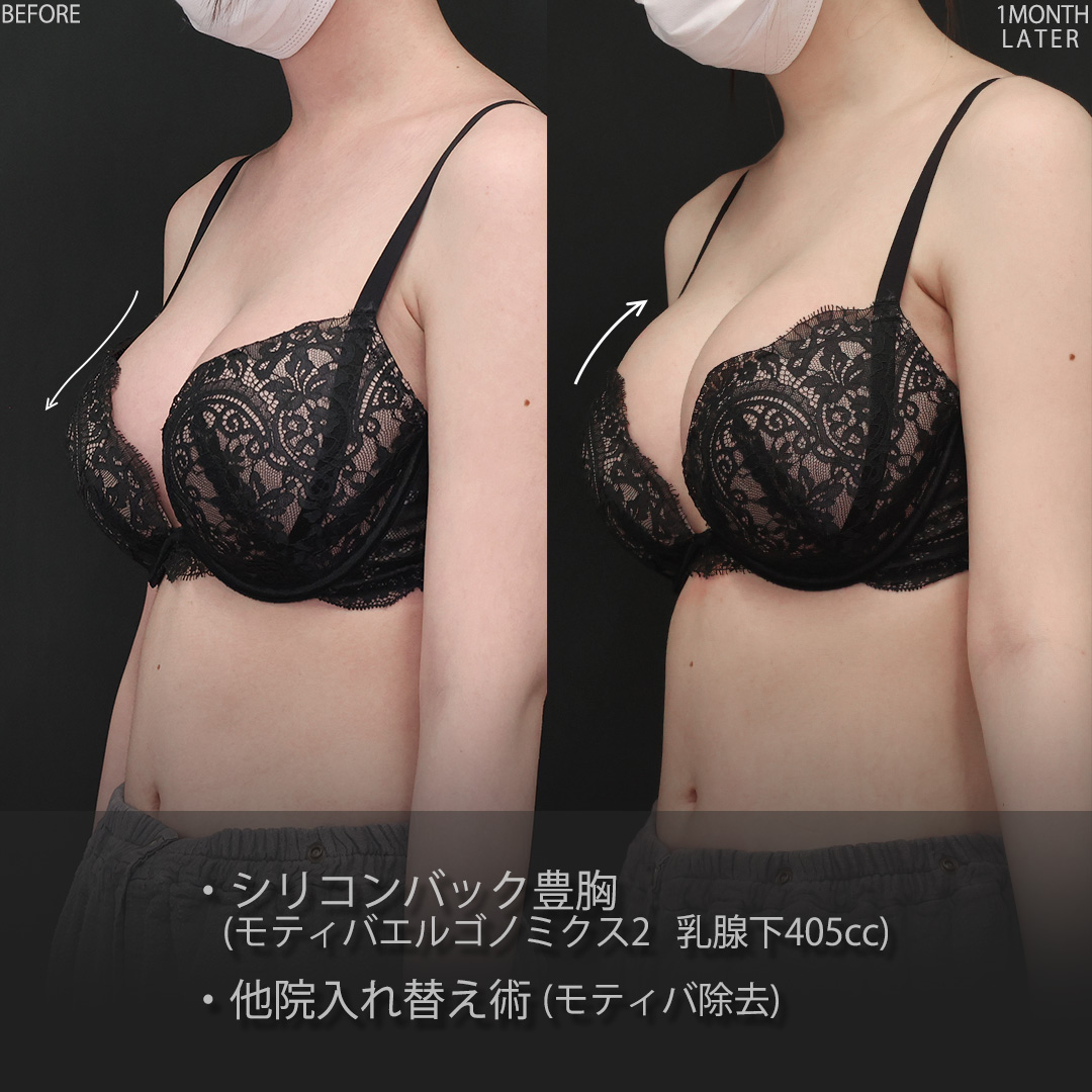 豊胸・バスト：その他/シリコンバッグ豊胸（人工乳腺バッグ）の症例写真 施術前後 