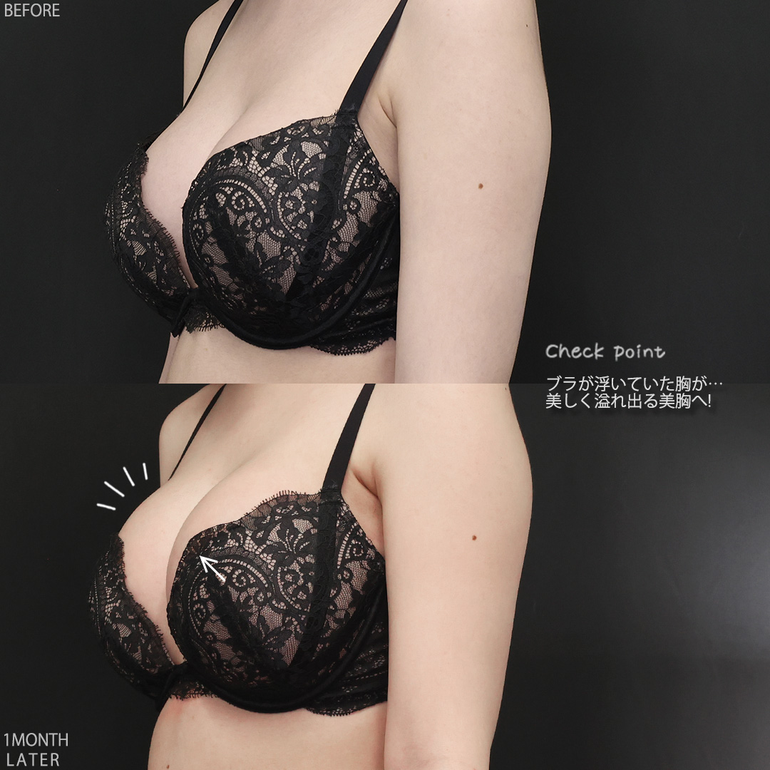 豊胸・バスト：その他/シリコンバッグ豊胸（人工乳腺バッグ）の症例写真 施術前後 