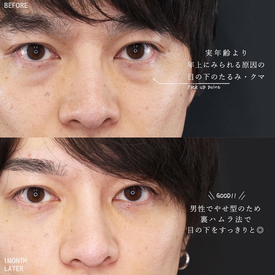 TAC式 ツヤ肌コラーゲンリフト®/TAC式 ショッピングリフト/ほうれい線のヒアルロン酸注射の症例写真 施術前後 