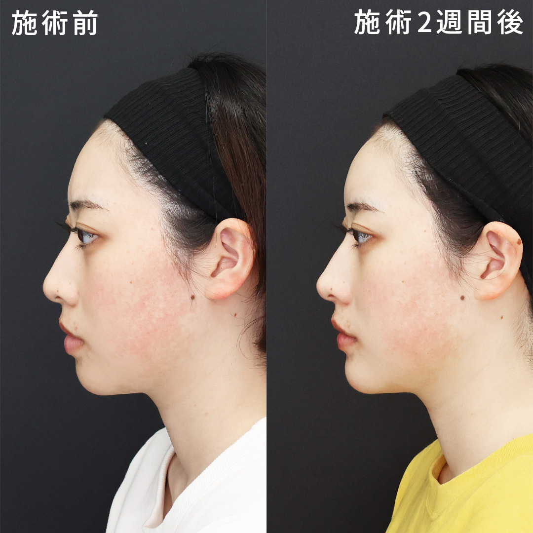 よりバランスが整う【プチ整形】で垢抜け|切らない鼻中隔延長×ヒアルロン酸注射