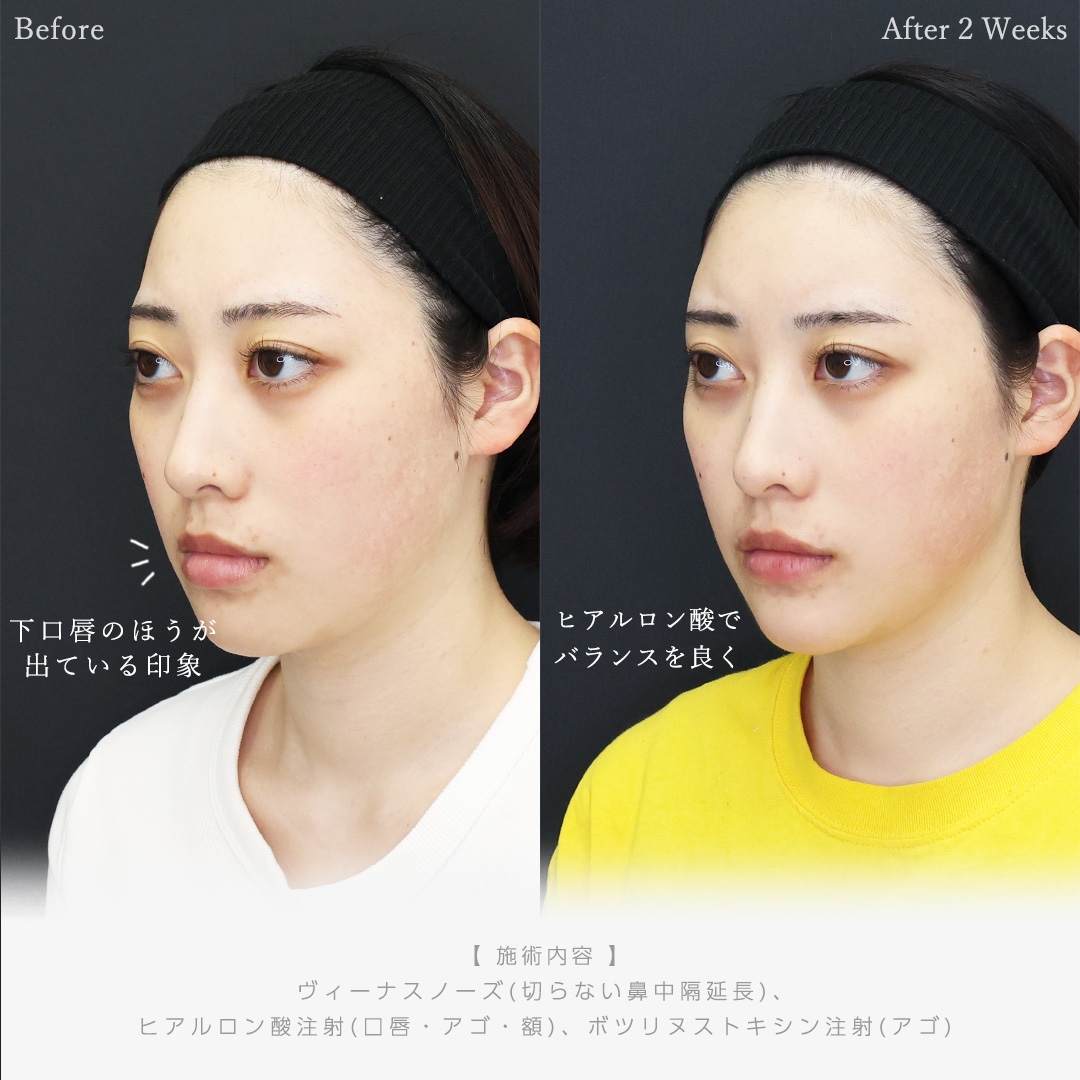 ヴィーナスノーズ（切らない鼻中隔延長術）/おでこ・こめかみのヒアルロン酸注射/顎のヒアルロン酸注射の症例写真 施術前後 