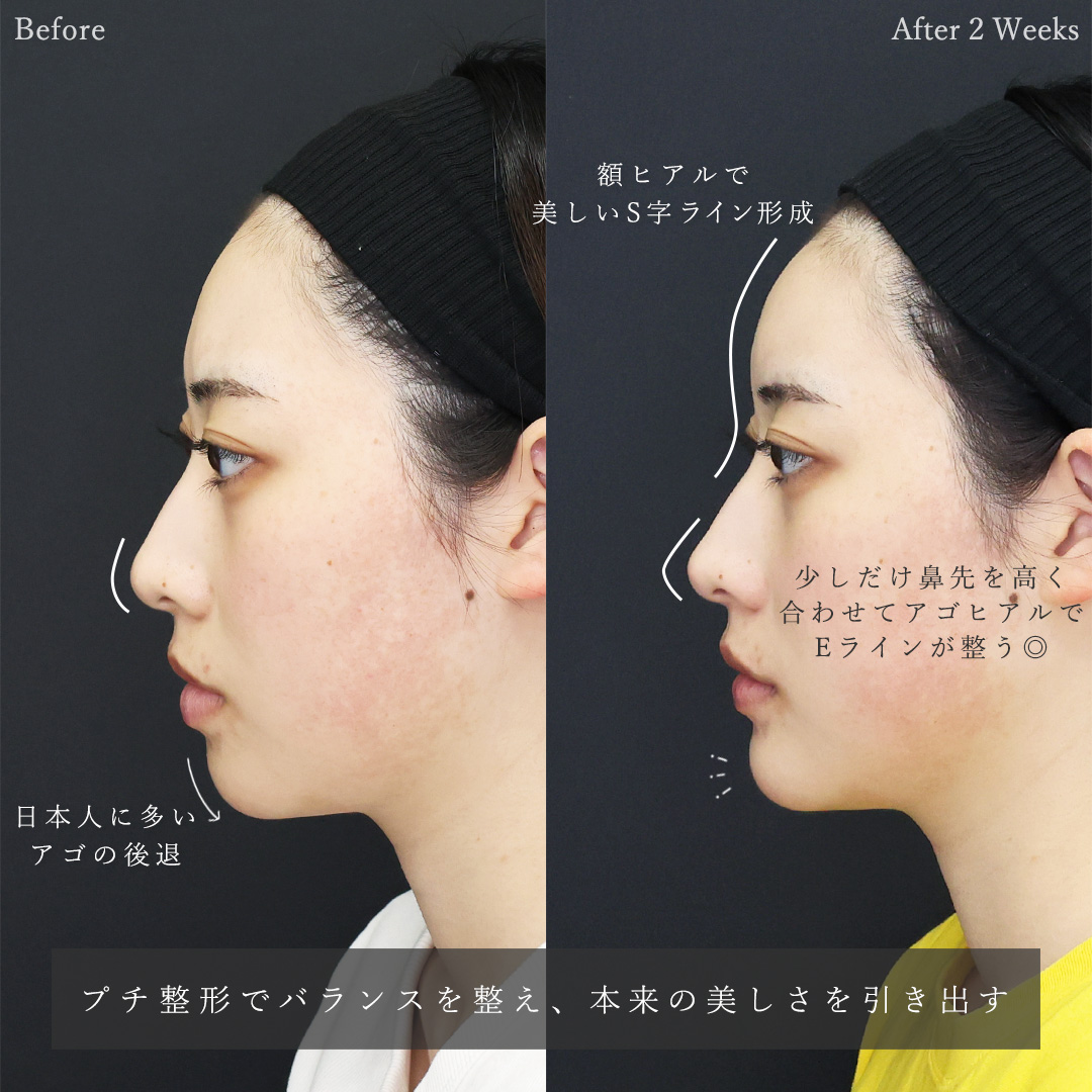 ヴィーナスノーズ（切らない鼻中隔延長術）/おでこ・こめかみのヒアルロン酸注射/顎のヒアルロン酸注射の症例写真 施術前後 