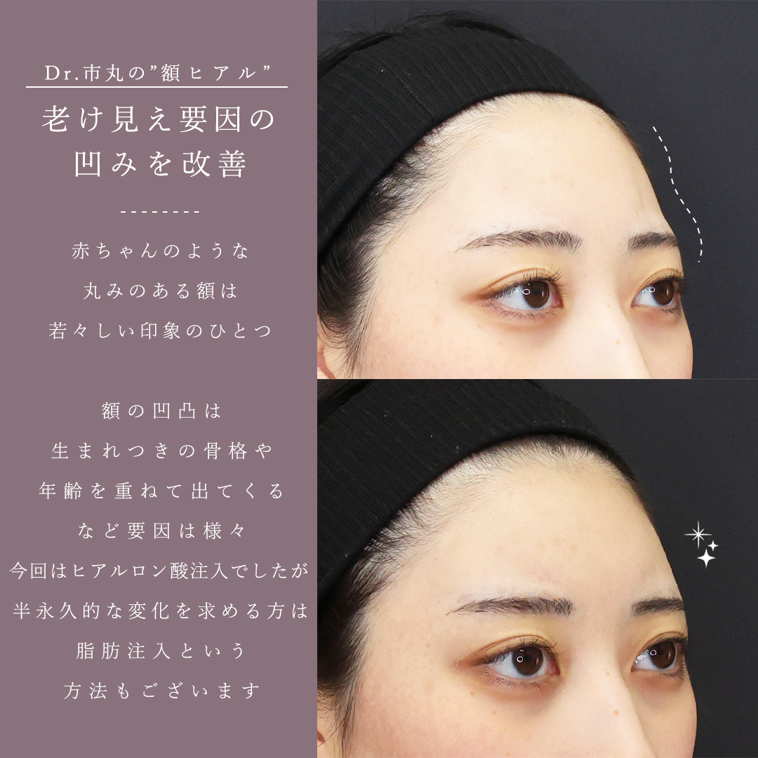 ヴィーナスノーズ（切らない鼻中隔延長術）/おでこ・こめかみのヒアルロン酸注射/顎のヒアルロン酸注射の症例写真 施術前後 