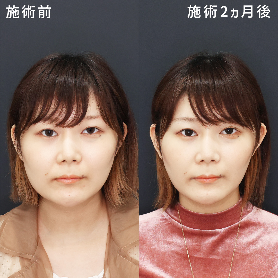 《糸リフト×脂肪吸引》痩せにくいお顔のお悩みを解決!