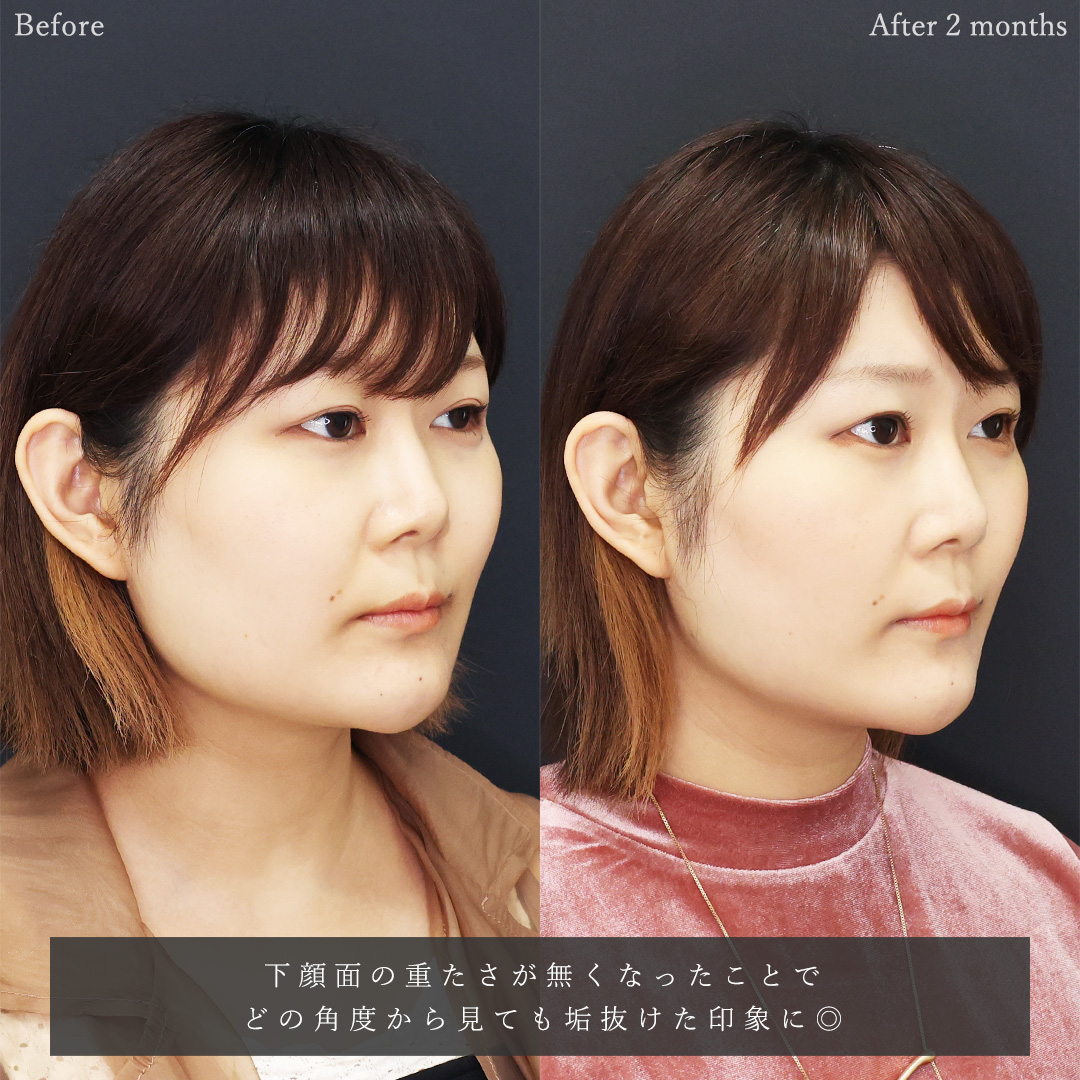 TAC式 ツヤ肌コラーゲンリフト®/ジョールファット除去/メーラーファット除去の症例写真 施術前後 