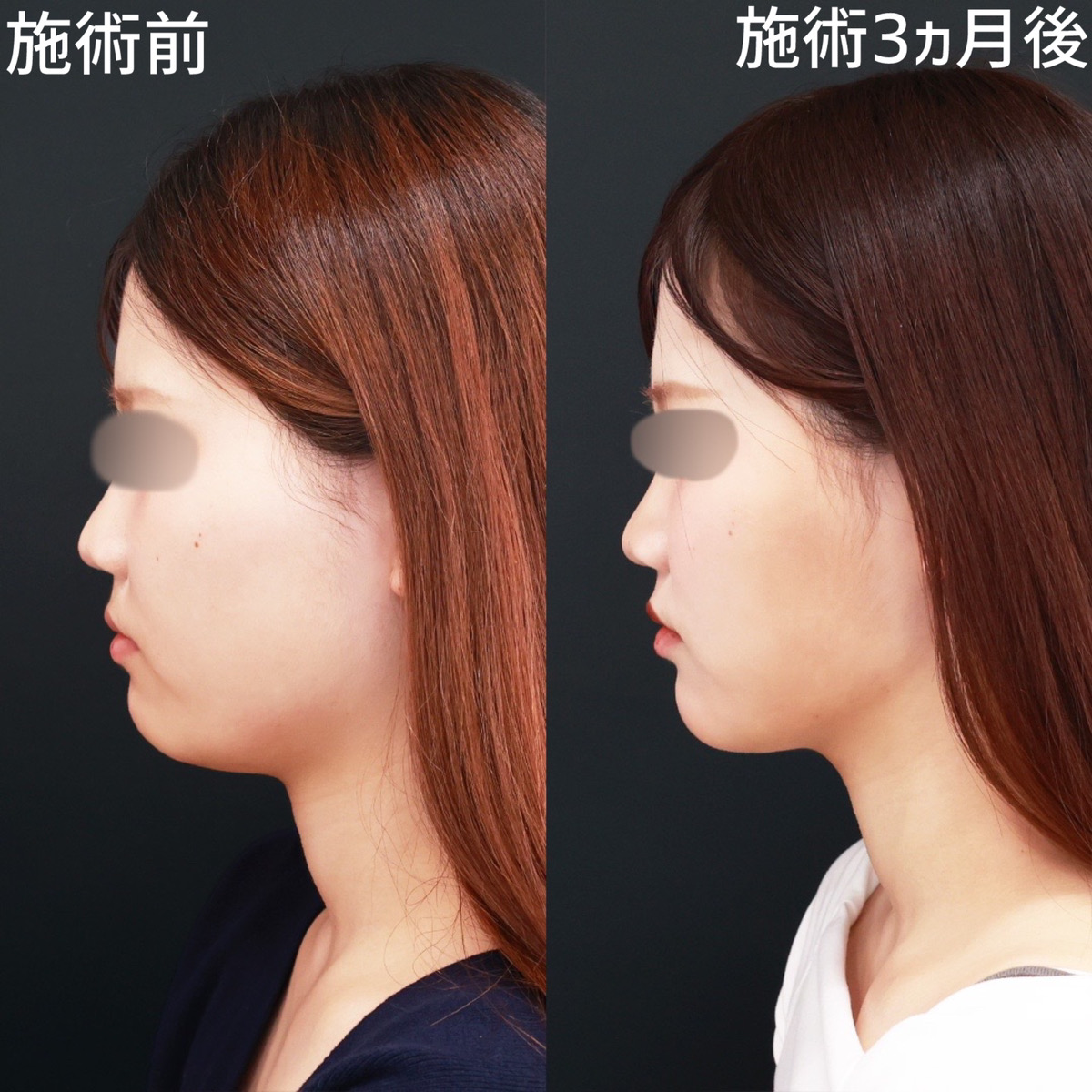 【顎下脂肪吸引×糸リフト極】二重顎を解消し、横顔をさらに美しく！