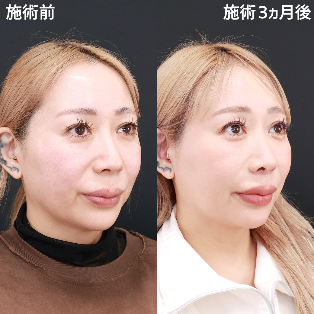 TAC式 鼻翼縮小術(小鼻縮小)/人中短縮術(リップリフト)・外側人中短縮術の症例写真 施術前後