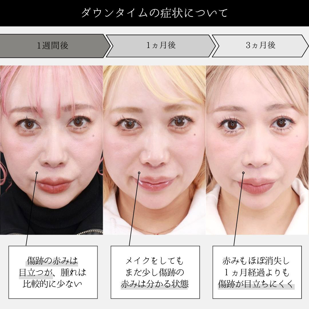 TAC式 鼻翼縮小術(小鼻縮小)/人中短縮術(リップリフト)・外側人中短縮術の症例写真 施術前後
