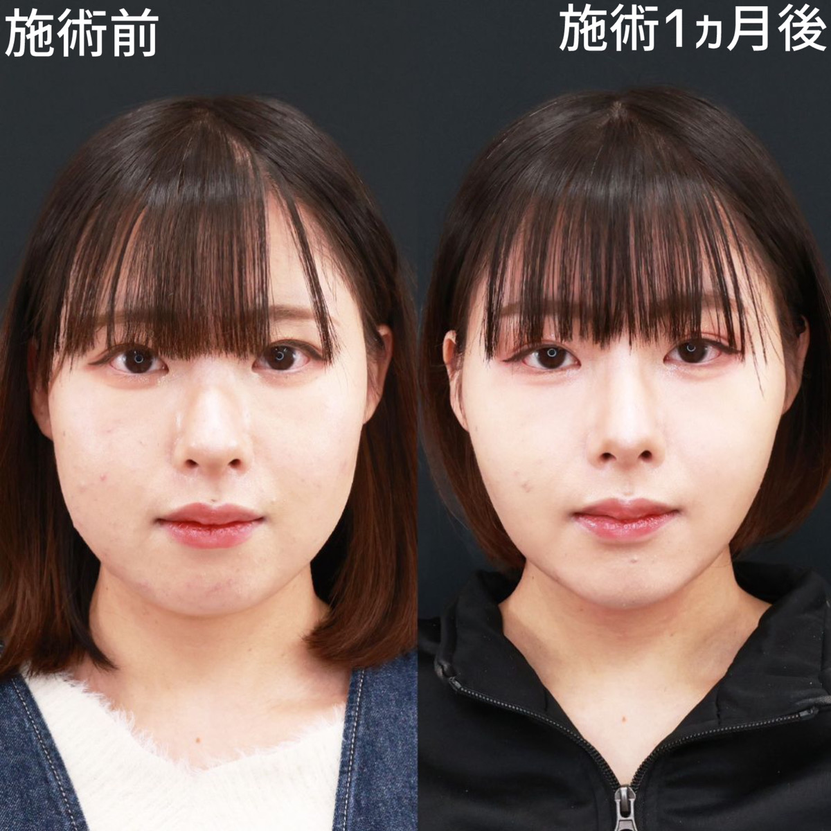 【ジョールファット除去×糸リフト極】下顔面のボリュームを、劇的にスッキリ！