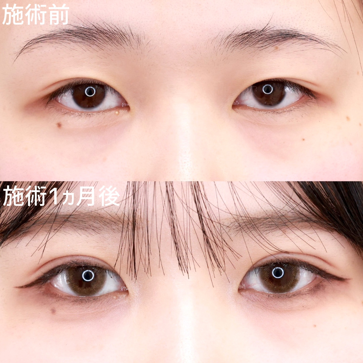 【二重埋没法】二重幅を自然に広げて、可愛さを劇的に上げる！