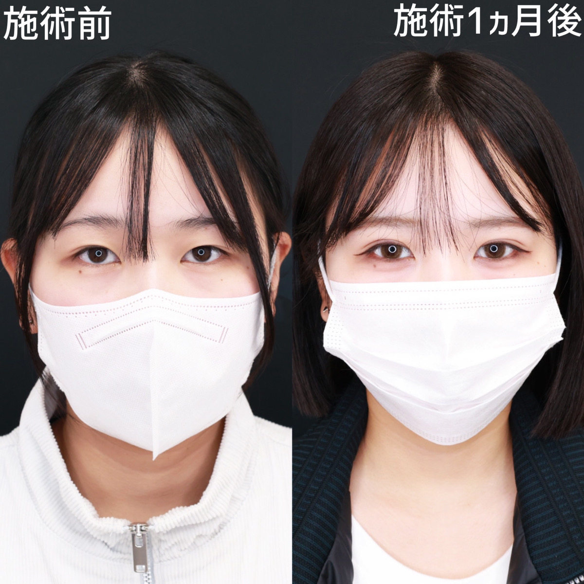 二重埋没法の症例写真 施術前後 