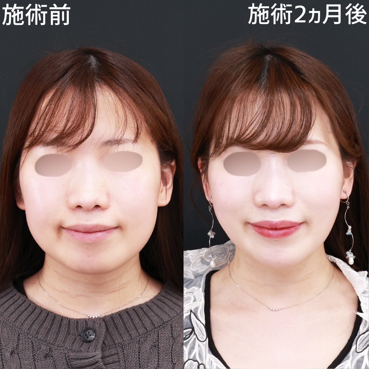 【ジョールファット除去×糸リフト極】頬肉を無くし、スッキリとした輪郭に！