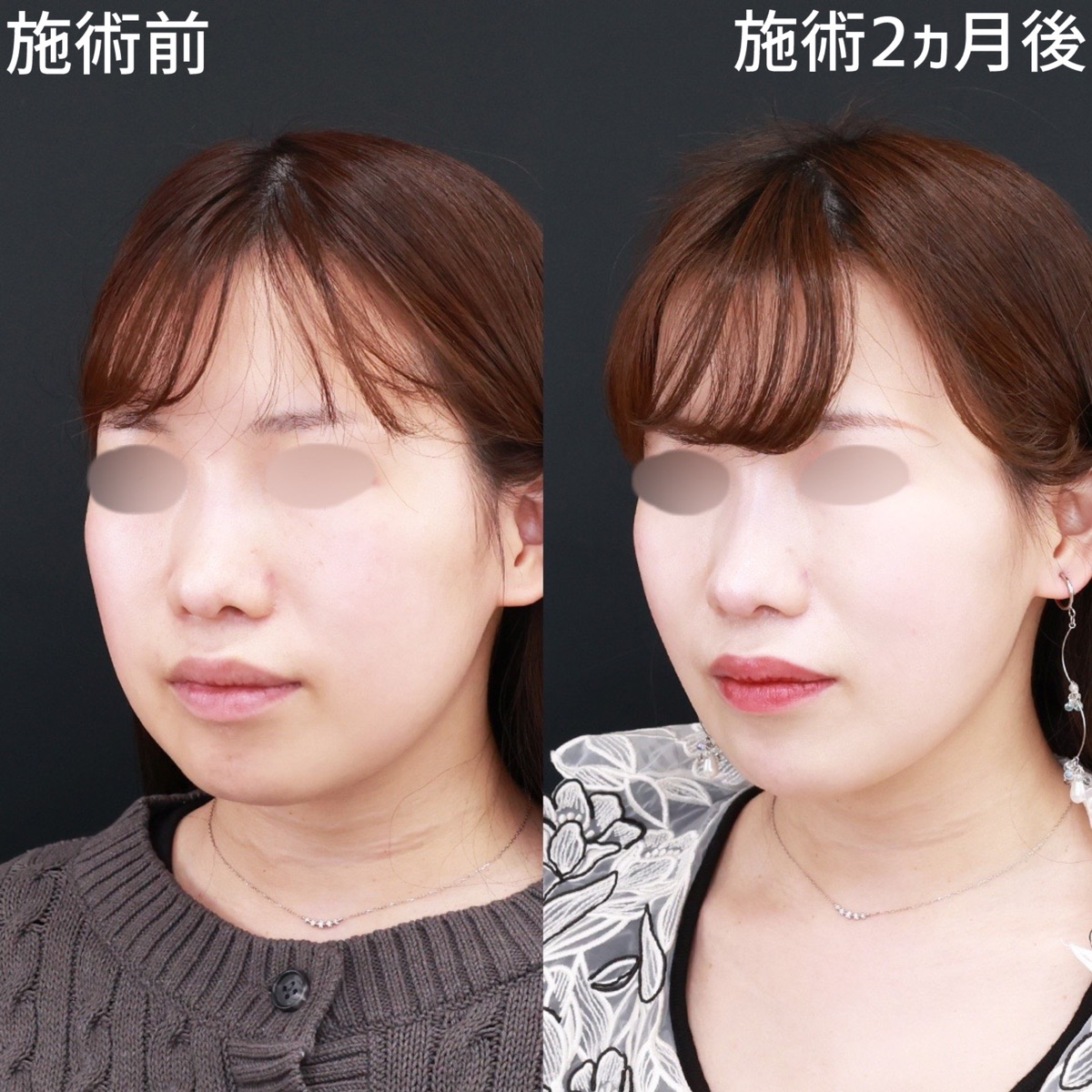 TAC式 ツヤ肌コラーゲンリフト®/ジョールファット除去/顎のヒアルロン酸注射の症例写真 施術前後 