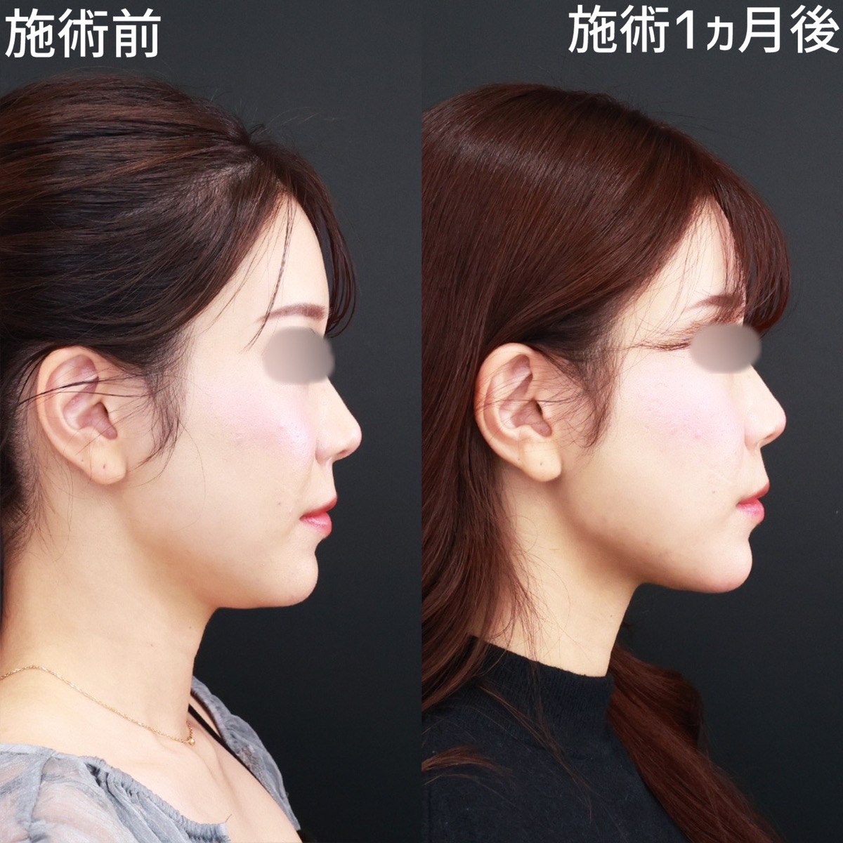 【顎下脂肪吸引×糸リフト極】クッキリと影が浮き出るほどの、美しいフェイスラインに!