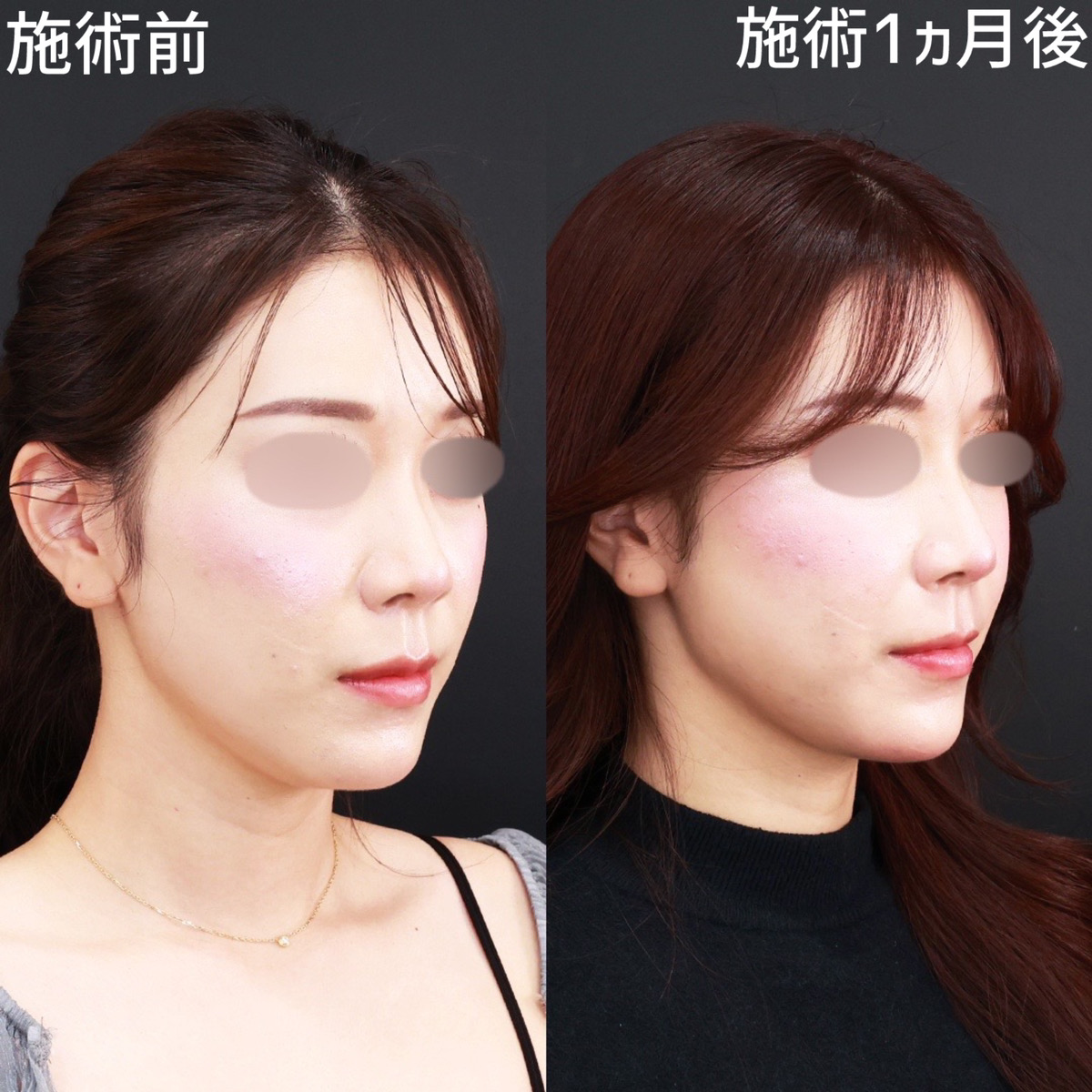 TAC式 ツヤ肌コラーゲンリフト®/顎下の脂肪吸引/Lラインファット除去（エラ下脂肪除去）の症例写真 施術前後 