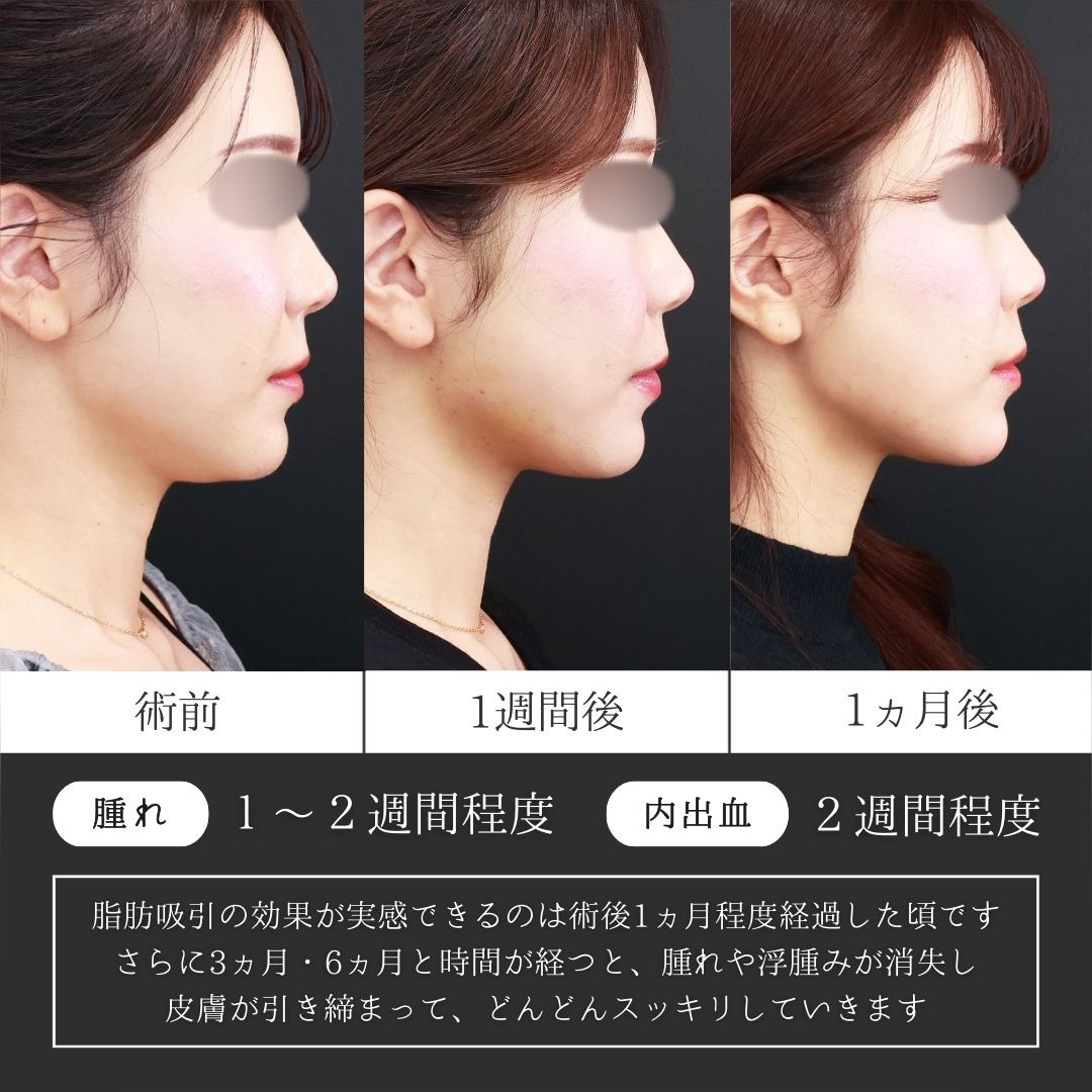 TAC式 ツヤ肌コラーゲンリフト®/顎下の脂肪吸引/Lラインファット除去（エラ下脂肪除去）の症例写真 施術前後 