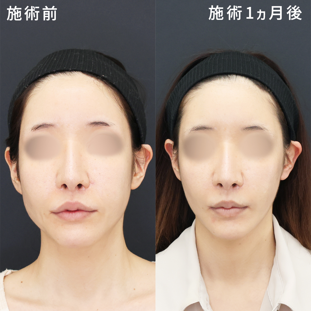 【30代】たるみ×ほうれい線解消│糸リフト
