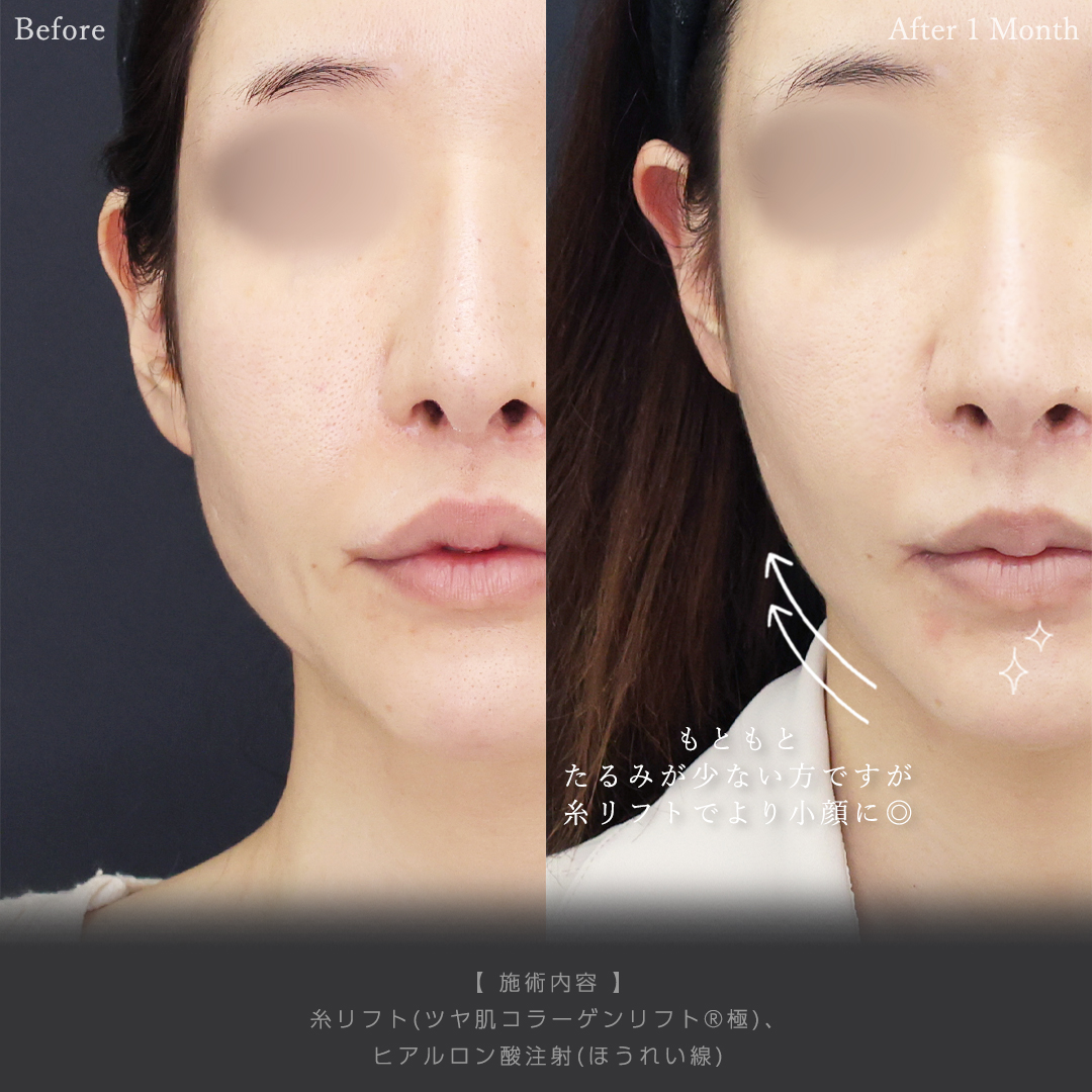 TAC式 ツヤ肌コラーゲンリフト®/ほうれい線のヒアルロン酸注射の症例写真 施術前後 