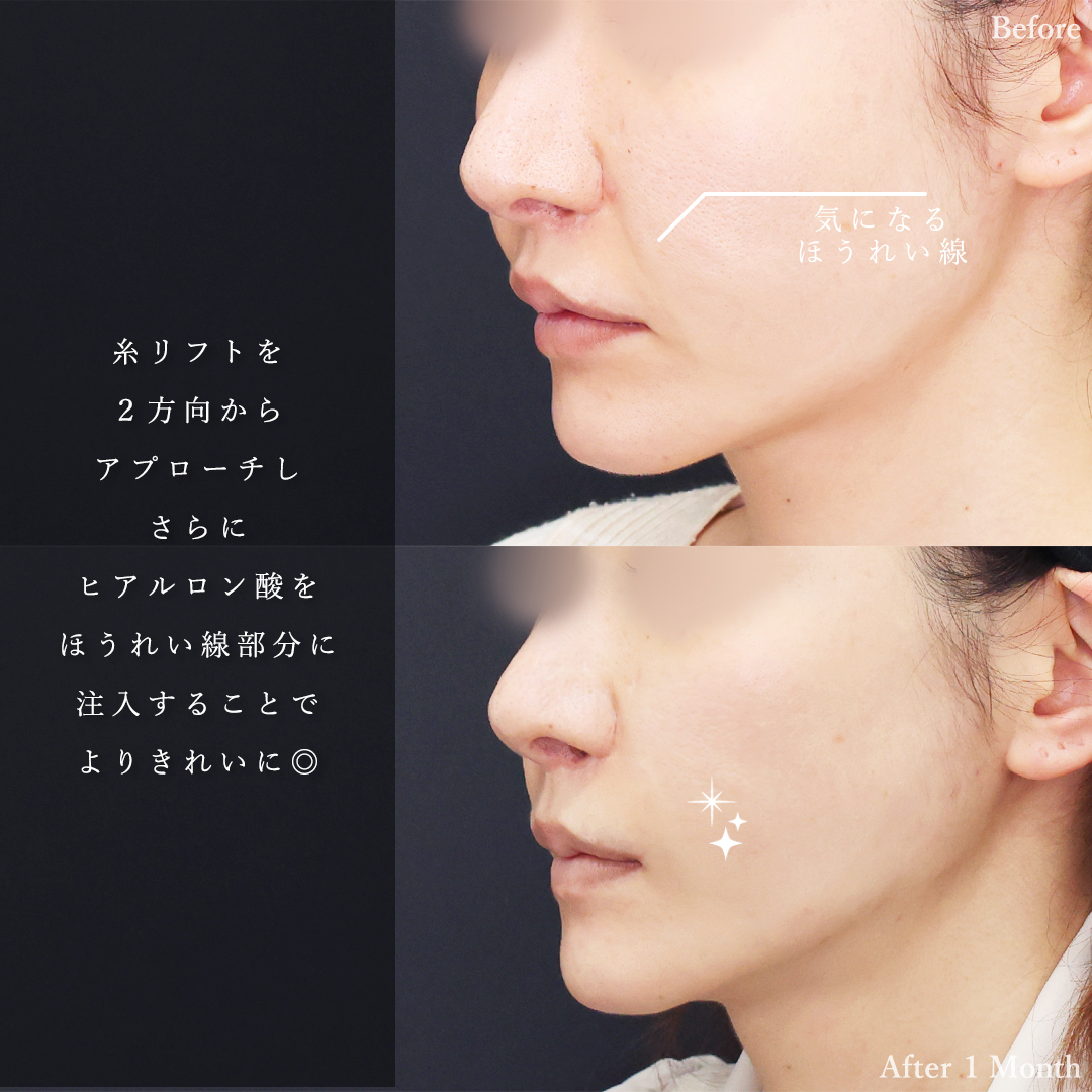 TAC式 ツヤ肌コラーゲンリフト®/ほうれい線のヒアルロン酸注射の症例写真 施術前後 