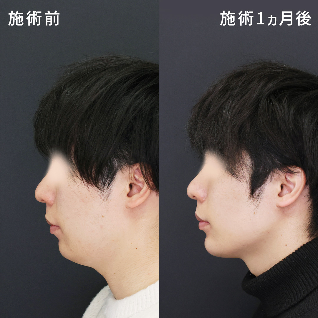 【本来の輪郭を引き出す】メンズ小顔整形|糸リフト×脂肪吸引