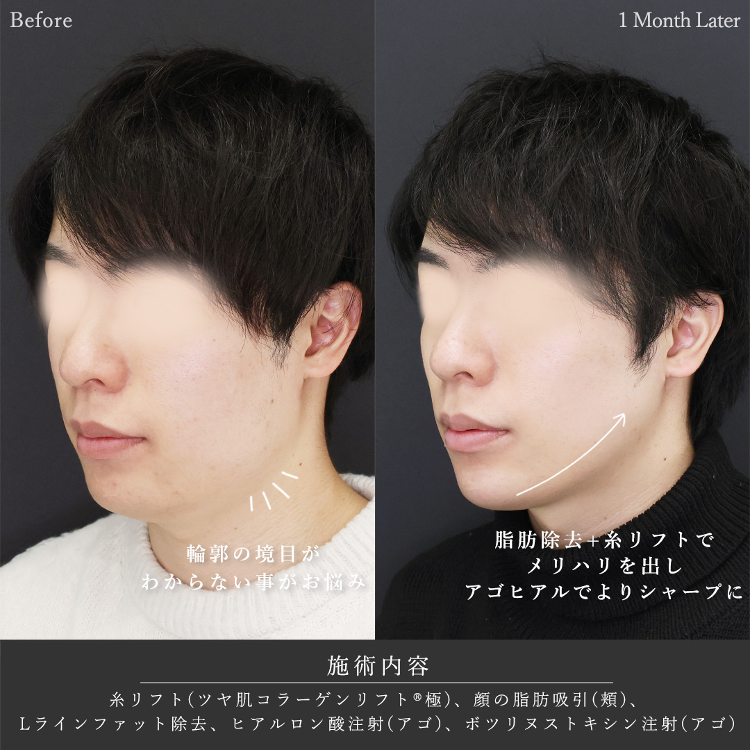 TAC式 ツヤ肌コラーゲンリフト®/Lラインファット除去（エラ下脂肪除去）/顔の脂肪吸引の症例写真 施術前後 