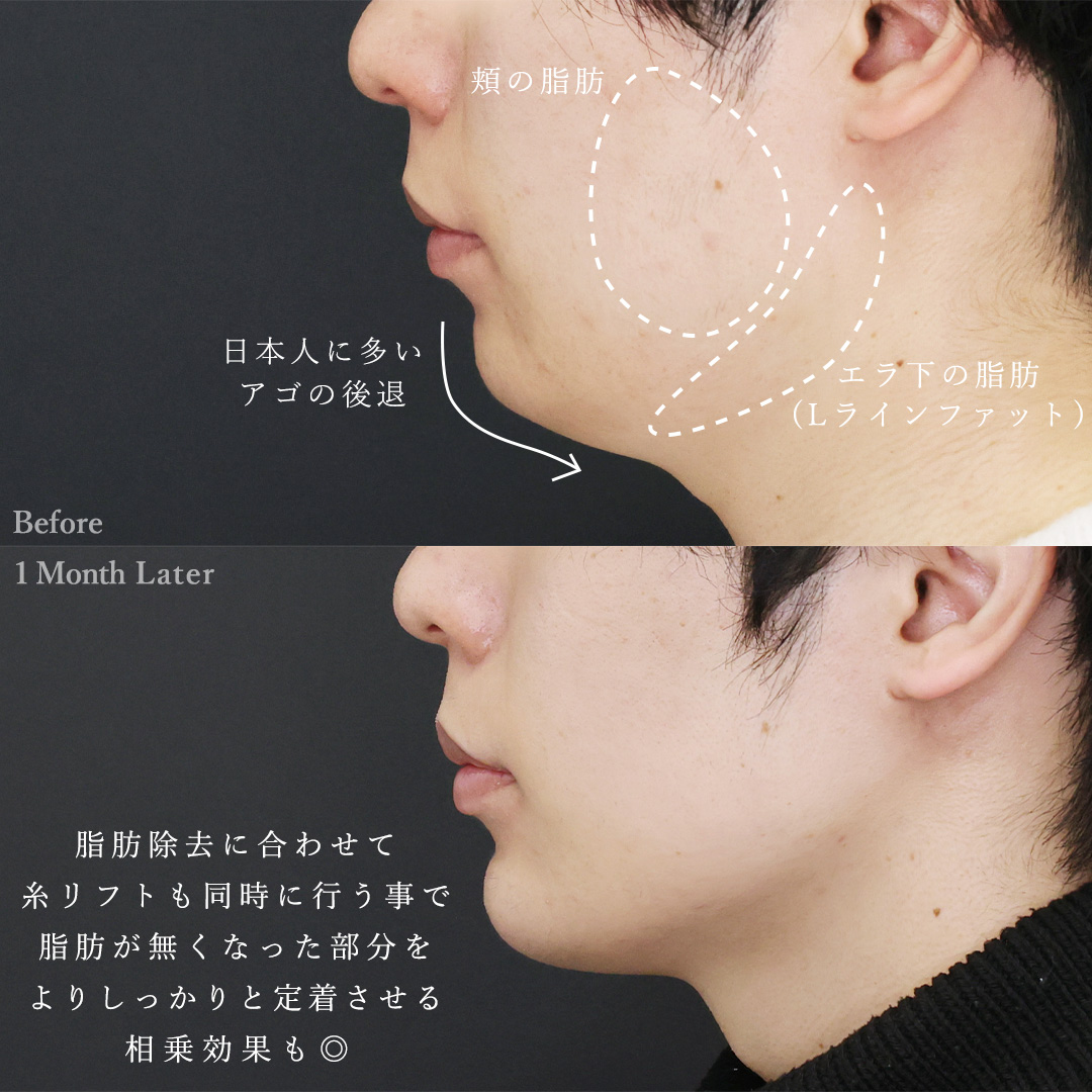 TAC式 ツヤ肌コラーゲンリフト®/Lラインファット除去（エラ下脂肪除去）/顔の脂肪吸引の症例写真 施術前後 