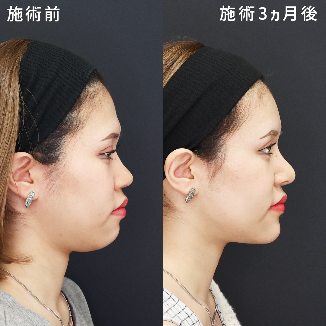 【形成外科専門医執刀】オーダーメイドフル整形│小顔×鼻×目元整形