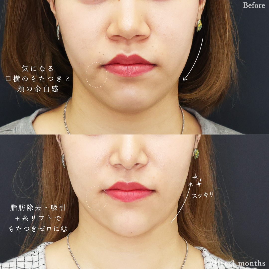 TAC式 ツヤ肌コラーゲンリフト®/ジョールファット除去/Lラインファット除去（エラ下脂肪除去）の症例写真 施術前後 