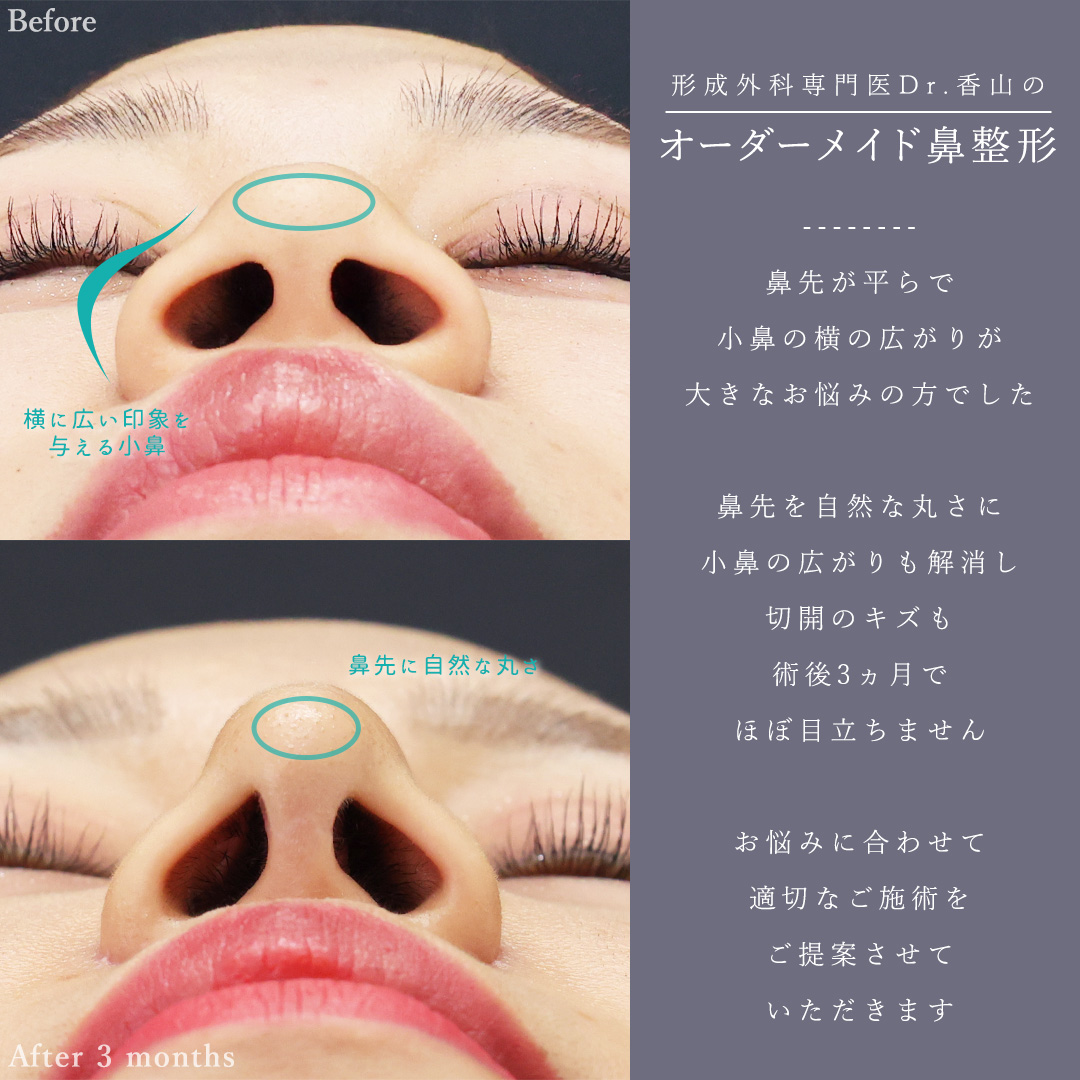 TAC式 ツヤ肌コラーゲンリフト®/ジョールファット除去/Lラインファット除去（エラ下脂肪除去）の症例写真 施術前後 
