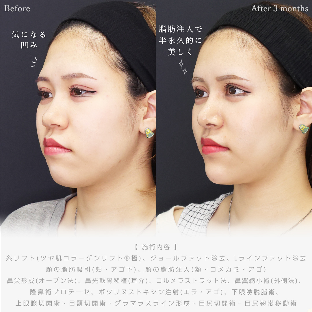 TAC式 ツヤ肌コラーゲンリフト®/ジョールファット除去/Lラインファット除去（エラ下脂肪除去）の症例写真 施術前後 