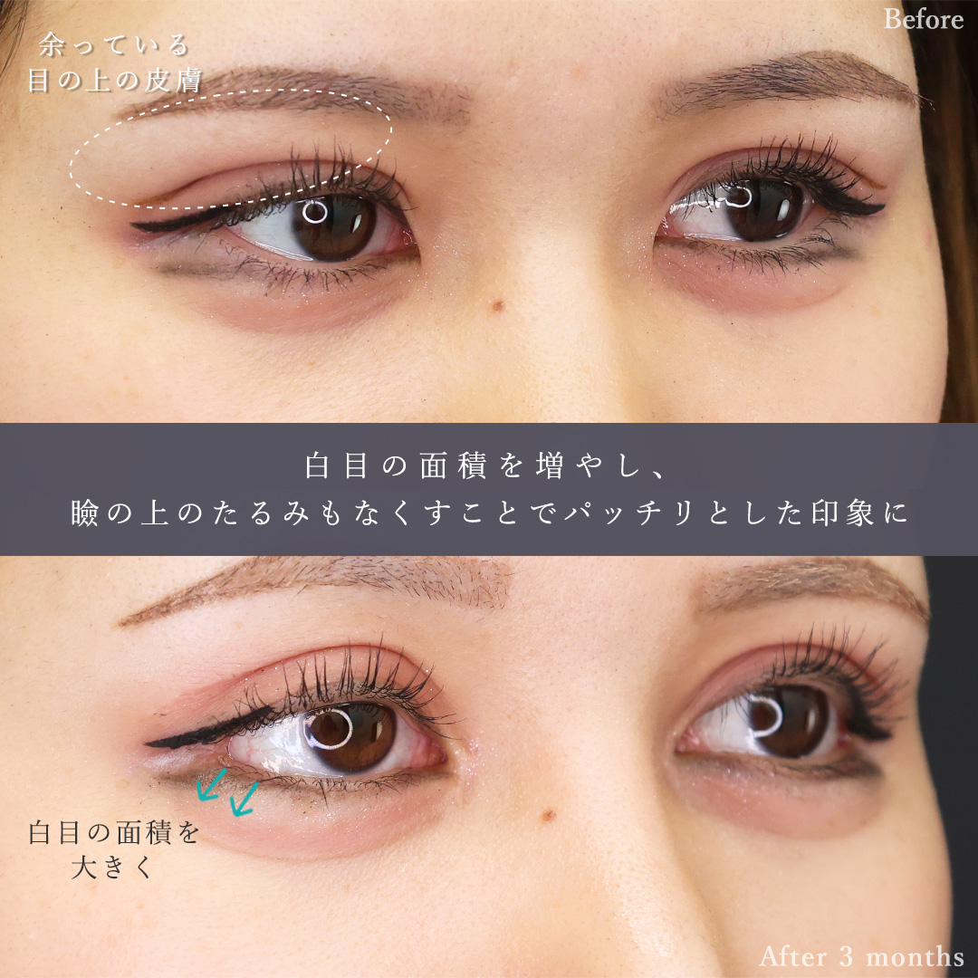 TAC式 ツヤ肌コラーゲンリフト®/ジョールファット除去/Lラインファット除去（エラ下脂肪除去）の症例写真 施術前後 