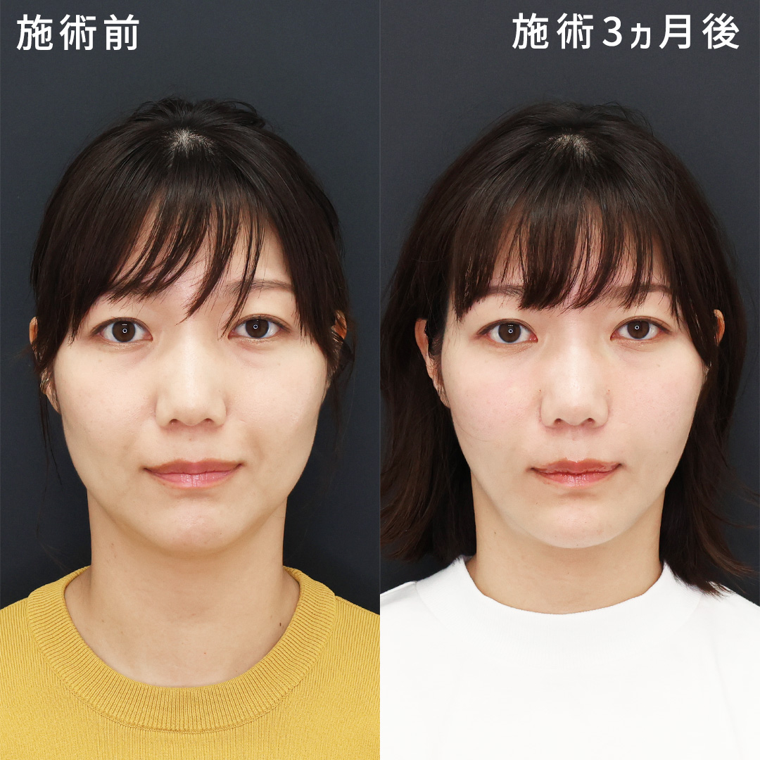 【30代】口周りのもたつき改善│若返り小顔術