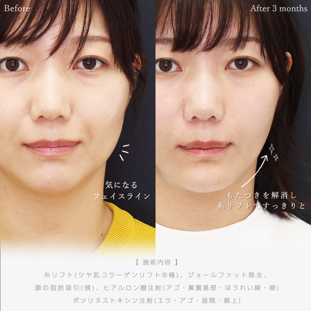 TAC式 ツヤ肌コラーゲンリフト®/ジョールファット除去/顔の脂肪吸引の症例写真 施術前後 