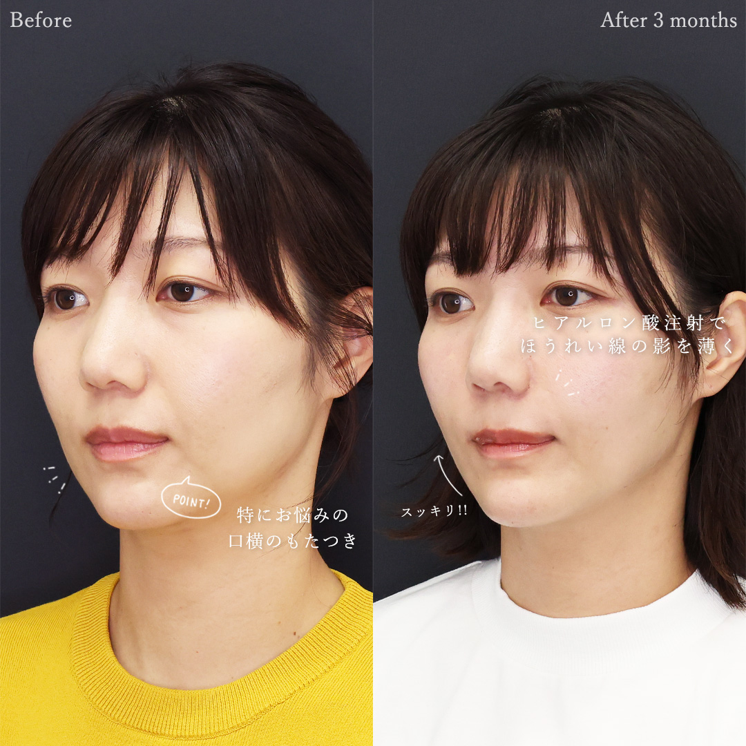 TAC式 ツヤ肌コラーゲンリフト®/ジョールファット除去/顔の脂肪吸引の症例写真 施術前後 
