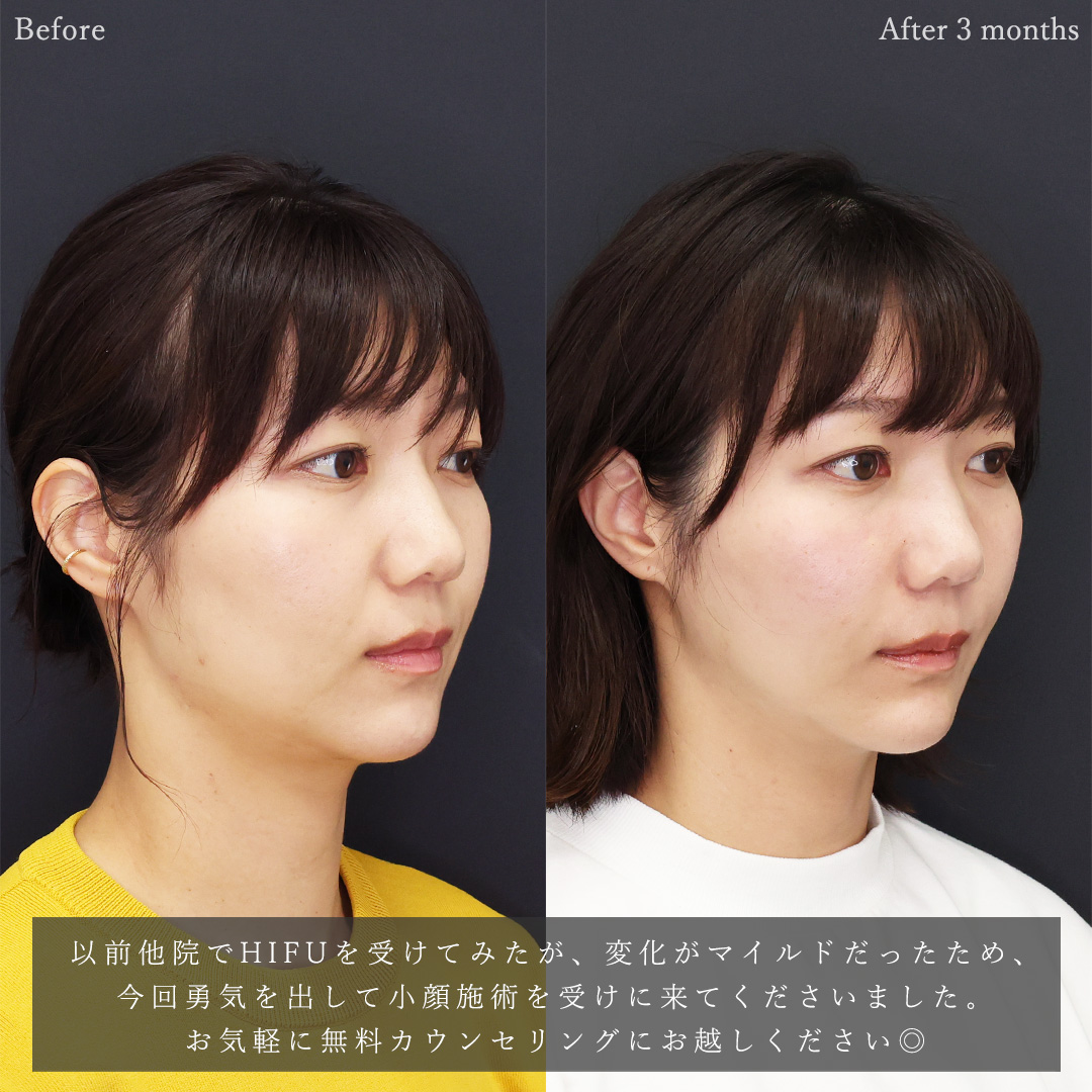 TAC式 ツヤ肌コラーゲンリフト®/ジョールファット除去/顔の脂肪吸引の症例写真 施術前後 