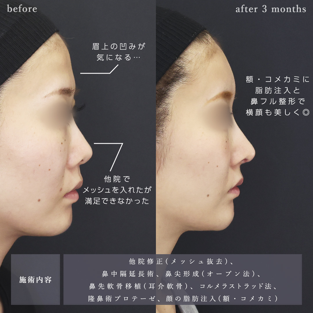 鼻中隔延長術/鼻尖形成・鼻尖縮小/鼻先軟骨移植の症例写真 施術前後 