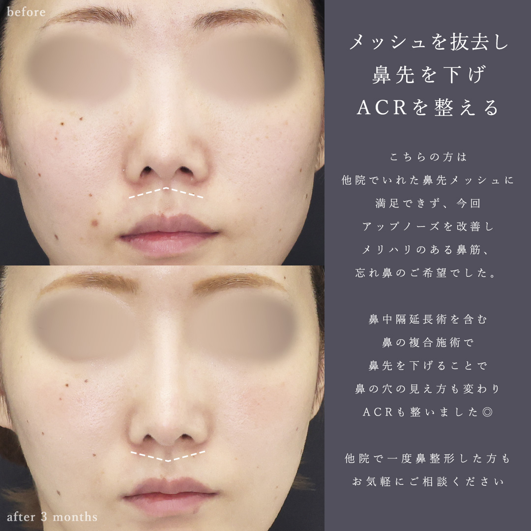鼻中隔延長術/鼻尖形成・鼻尖縮小/鼻先軟骨移植の症例写真 施術前後 