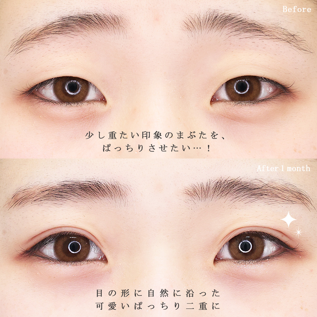 二重埋没法の症例写真 施術前後