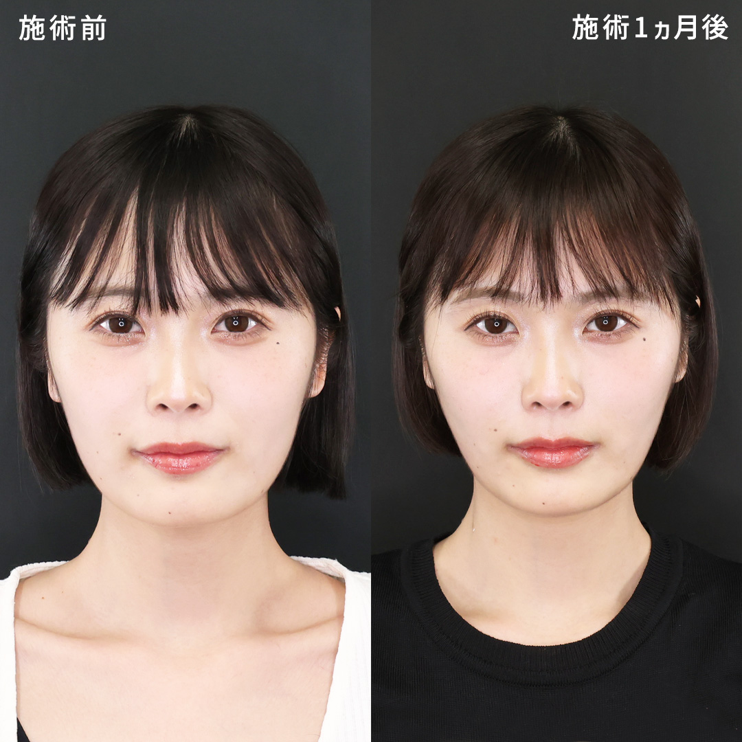 ほうれい線を薄く│糸リフト×ヒアルロン酸