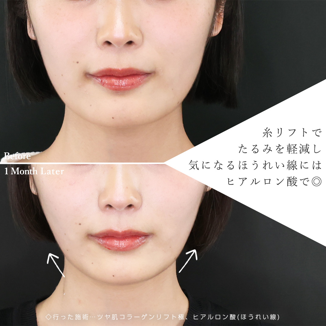 TAC式 ツヤ肌コラーゲンリフト®/ほうれい線のヒアルロン酸注射の症例写真 施術前後 