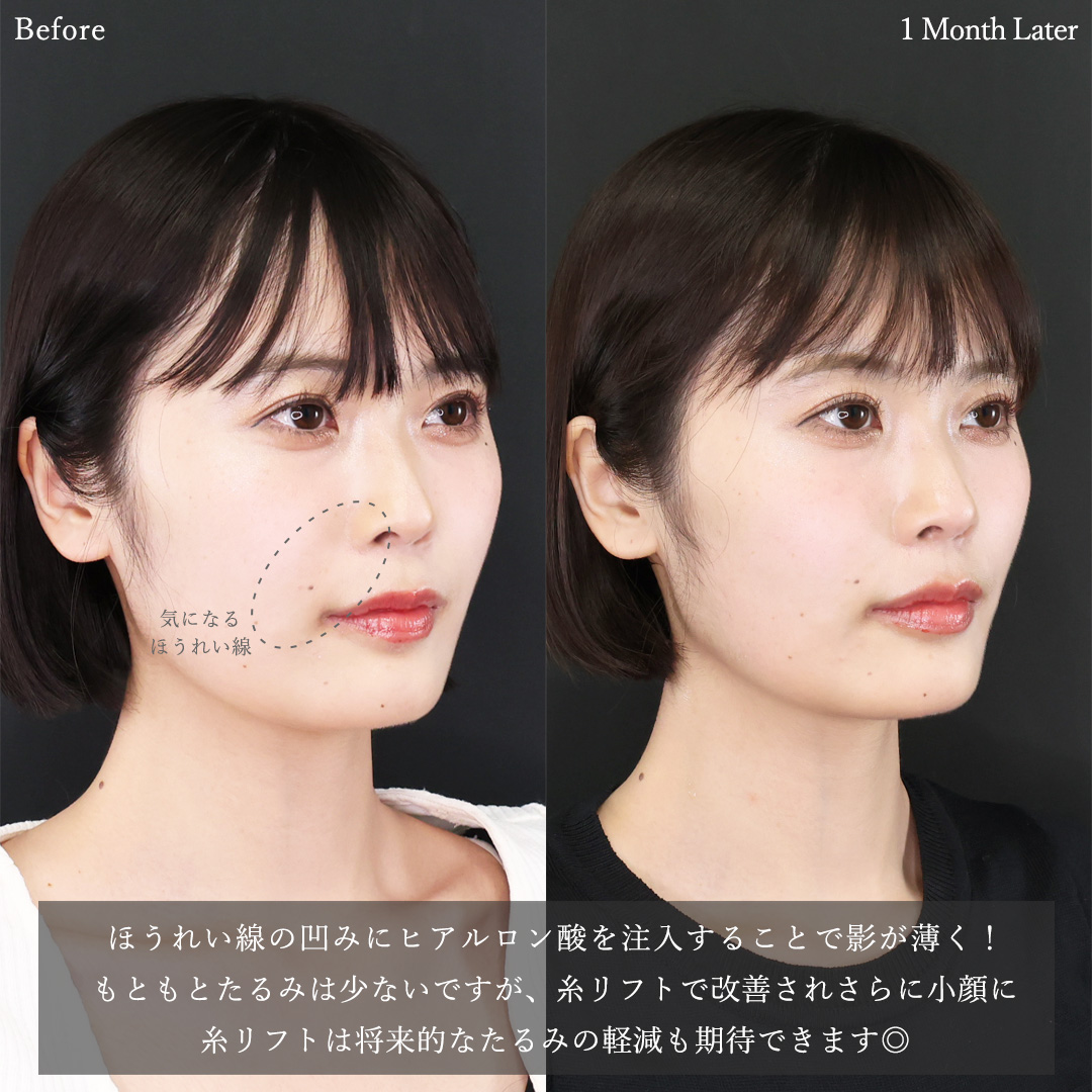 TAC式 ツヤ肌コラーゲンリフト®/ほうれい線のヒアルロン酸注射の症例写真 施術前後 