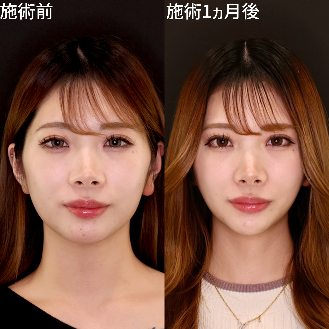 ダウンタイムを大公開！韓国流小顔脂肪吸引で韓国アイドルのようなバブみある綺麗な卵型フェイスラインに