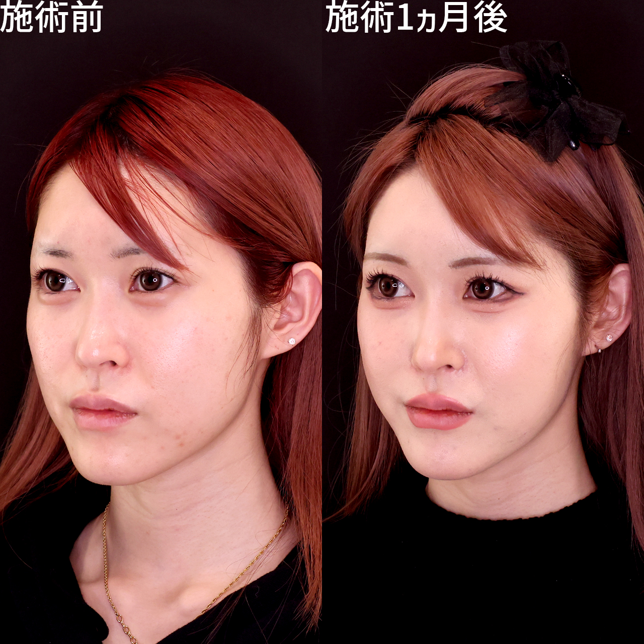 ジョールファット除去/顔の脂肪吸引/TAC式 ツヤ肌コラーゲンリフト®の症例写真 施術前後 