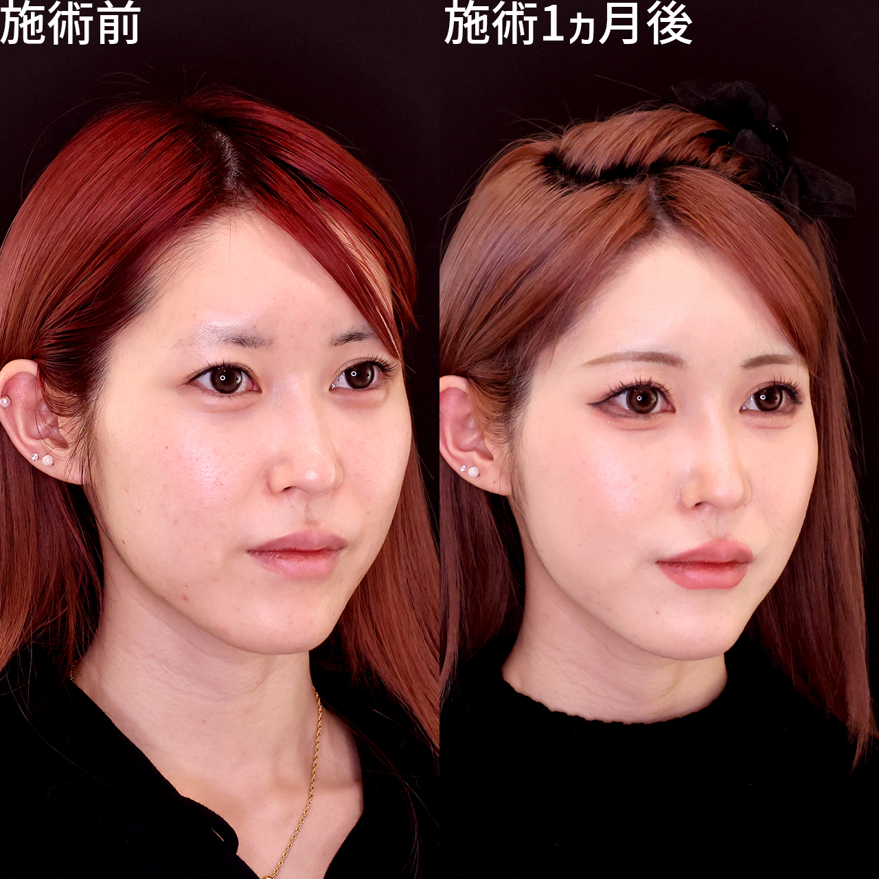 ジョールファット除去/顔の脂肪吸引/TAC式 ツヤ肌コラーゲンリフト®の症例写真 施術前後 